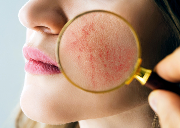 couperosa suurennuslasilla katsottuna.