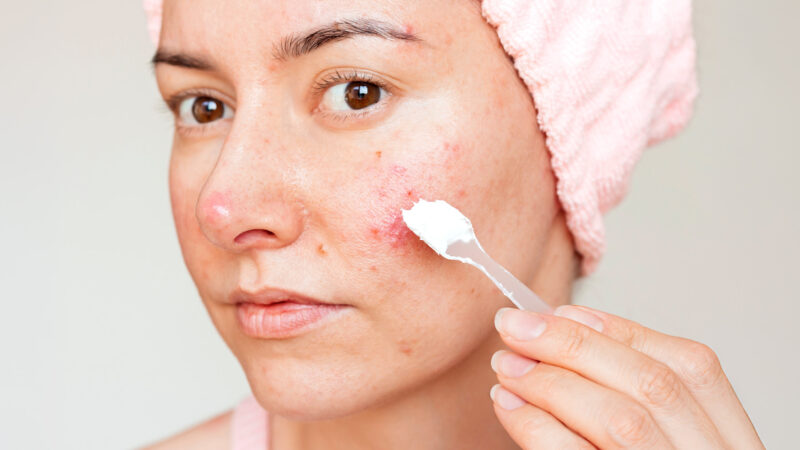 Nuori nainen, joka kärsii ruusufinnistä.